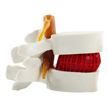 Модел Гръбначен стълб Лумбална херния Диск Човешки модели Анатомични прешлени Анатомия Гръбначен Преподаване Междупрешленна хиропрактика